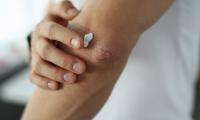 Psoriasis