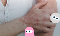 Nærbillede af en hånd og arm med psoriasis på - strøet med små grafiske, farvede figurer med runde øjne, der stirrer.
