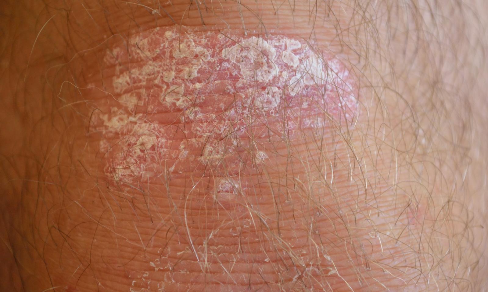 Symptomer | Psoriasisforeningen